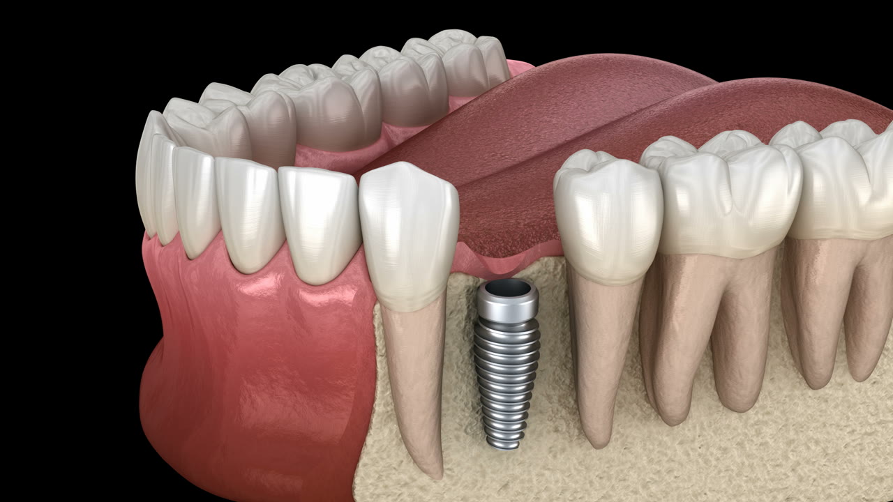 Wizualizacja implantu stomatologicznego w łuku zębowym
