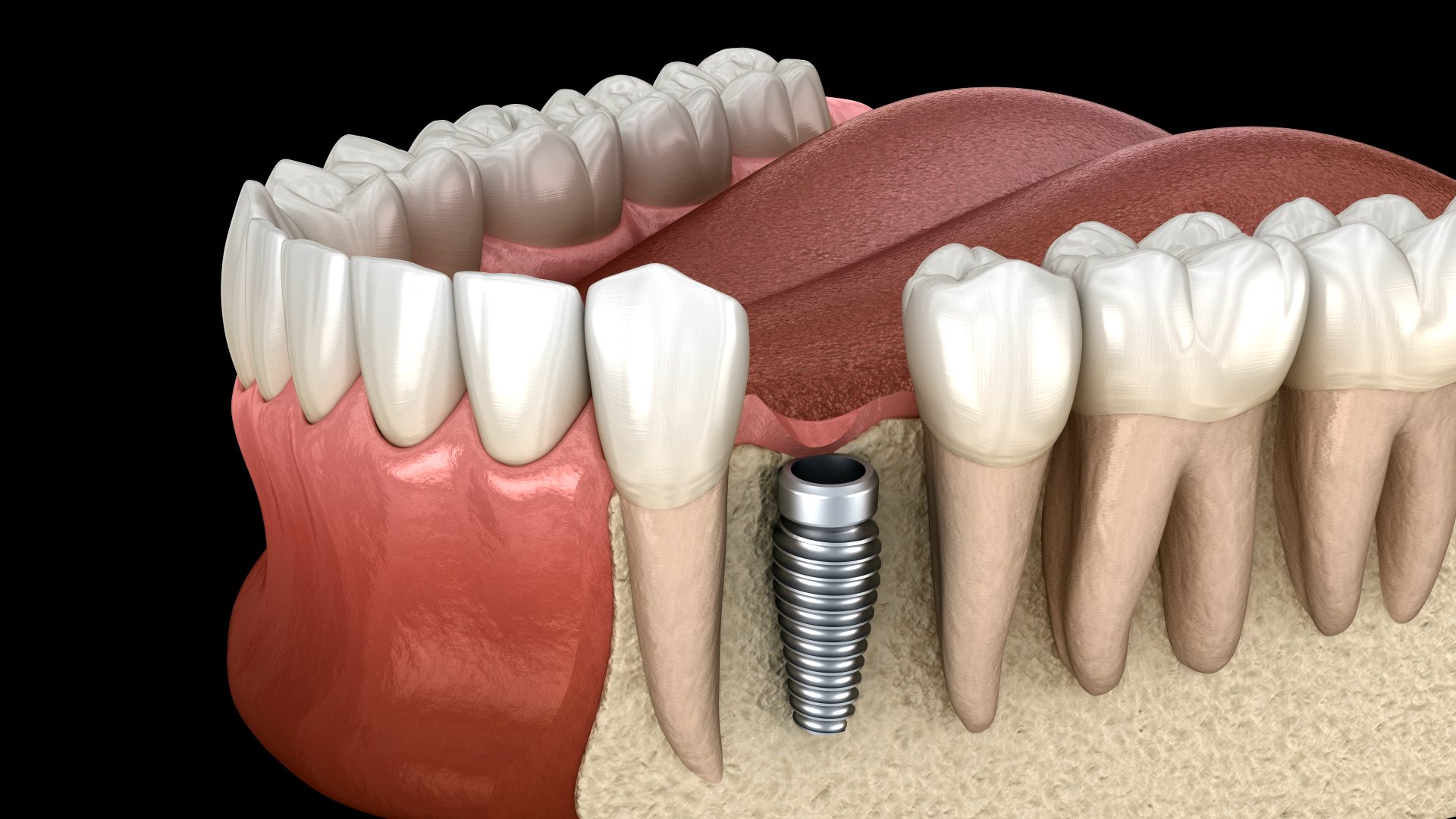 Wizualizacja implantu stomatologicznego